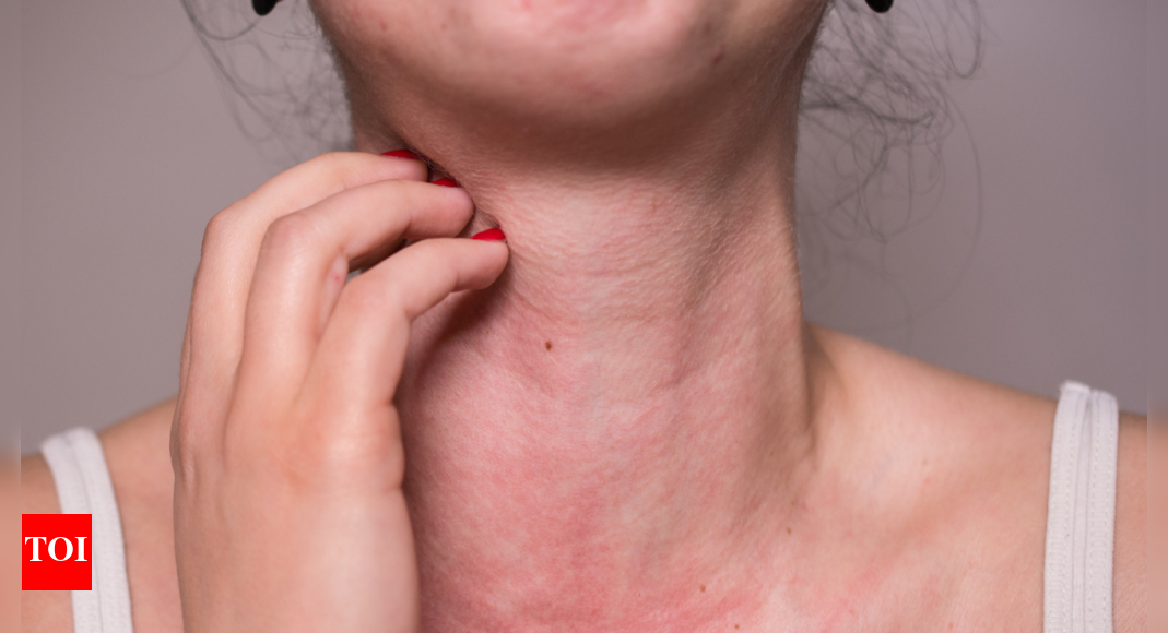 Food Allergy: Are you allergic to some food? 5 ways to almost guess it at home without tests |