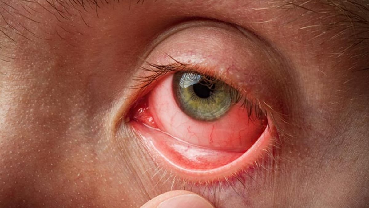 Why Conjunctivitis Peaks During the Monsoon Months?
