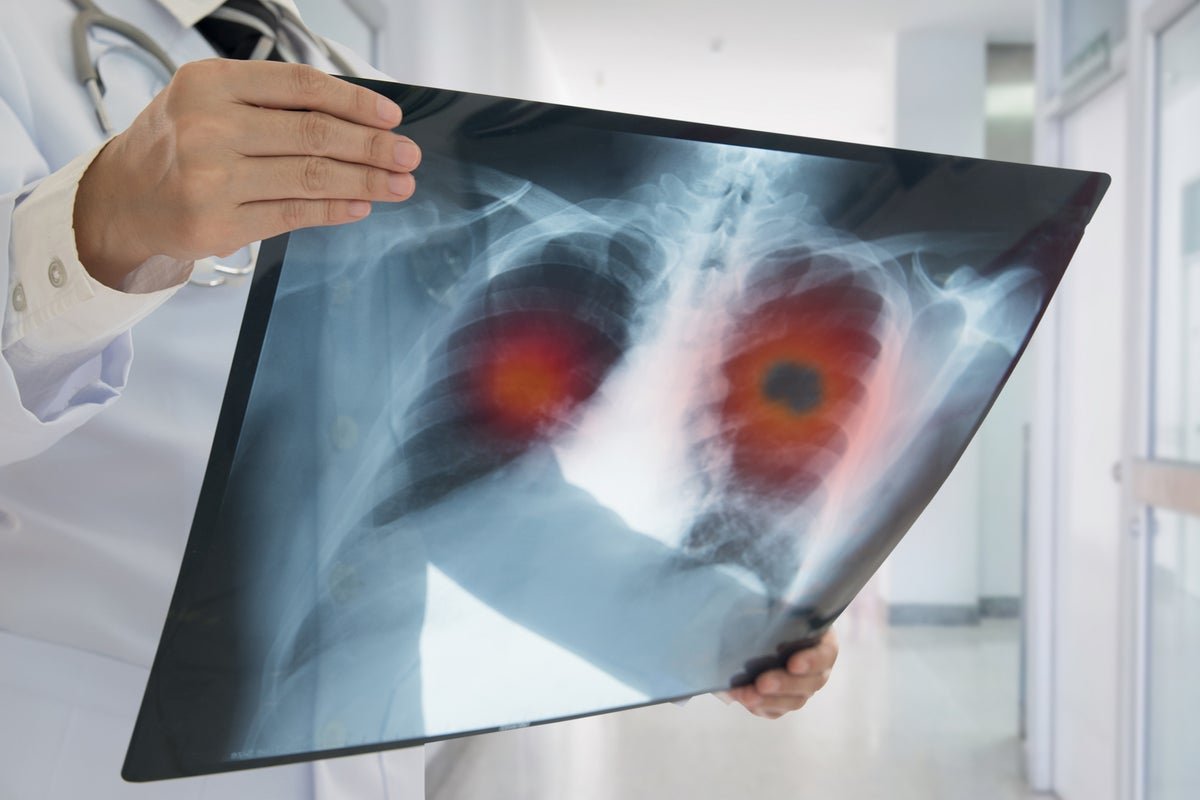 Scientists say these small health issues might be an early sign of lung cancer