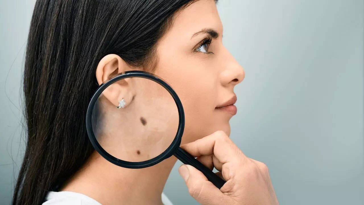 Is that mole dangerous? How to spot early signs of skin cancer