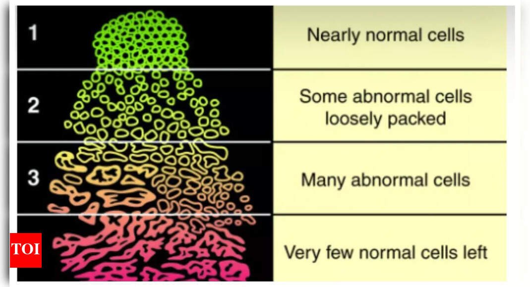 Prostate Cancer: What is the Gleason score in prostate Cancer and why early testing is crucial |
