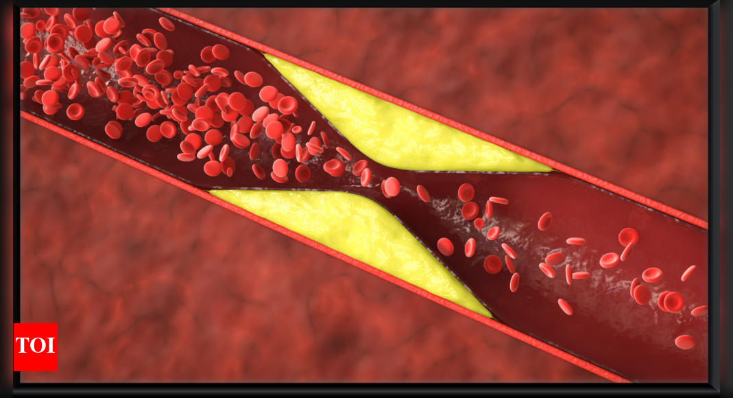 High Cholesterol Symptoms: 5 silent symptoms of high cholesterol that may go unnoticed |
