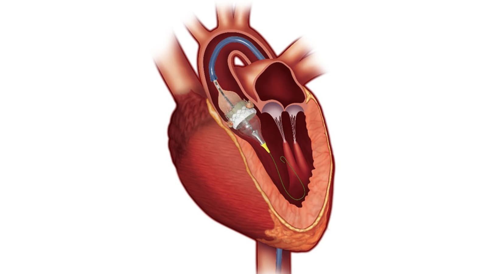 Beyond Blockages: Structural Heart Disease and the Rise of Minimally Invasive Solutions