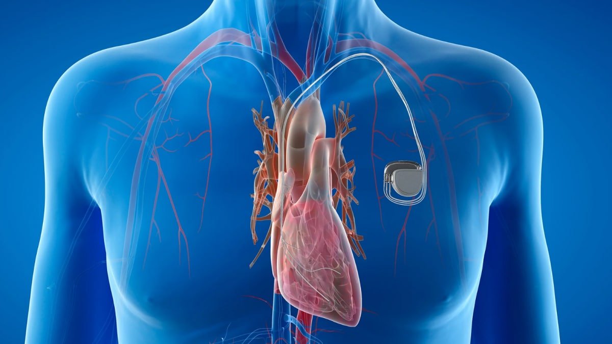 Protecting Every Beat: The Lifesaving Role of Pacemakers and ICDs | Health and Fitness News