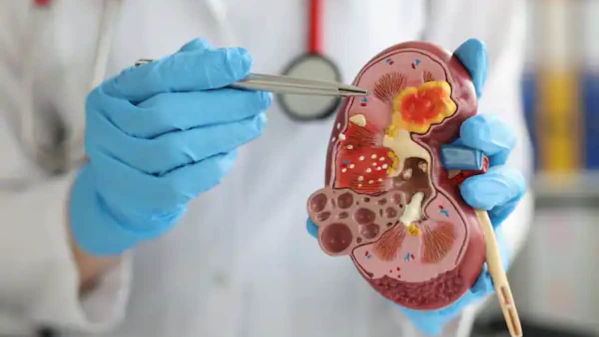 World Kidney Cancer Day: What Are The Causes, Symptoms And Prevention? | Lifestyle News