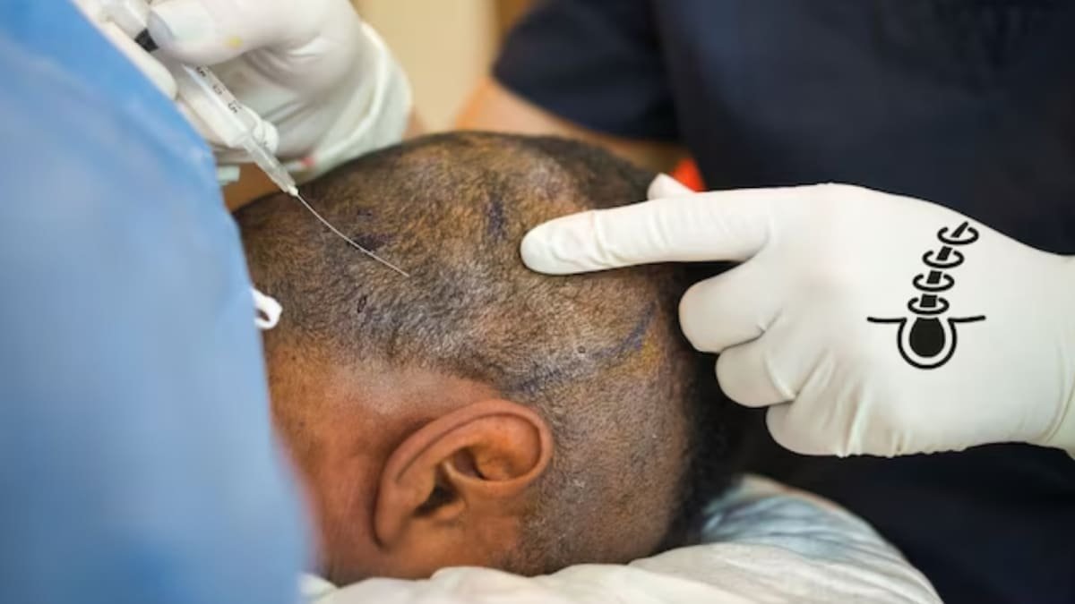 Hair Transplants Are Medical Surgeries And Not Salon Services: The Deadly Cost of Unregulated Transplants