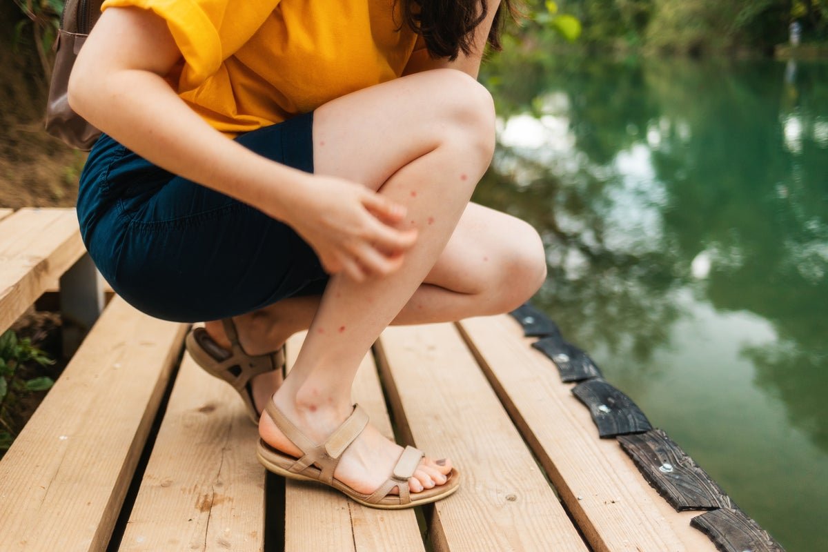 From mosquitoes to ticks: How to identify and treat different insect bites