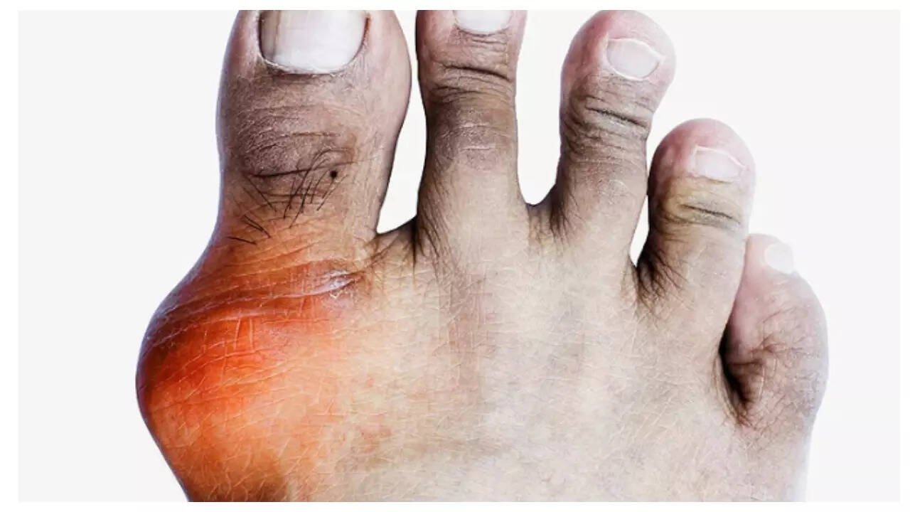 7 ways uric acid silently harms the body even before its symptoms are felt