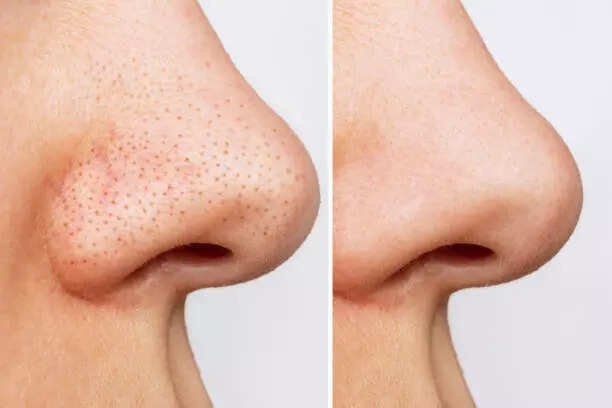 5 desi hacks to get rid of Blackheads