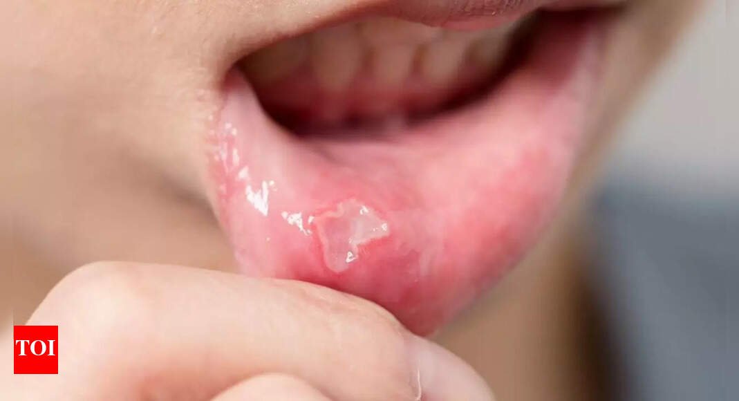 What is oral cancer: Know its symptoms, causes, and why early detection may save your life |