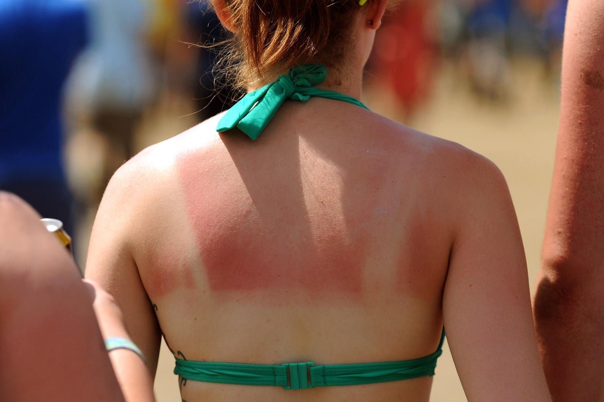 What to do after a burn: from sunburn to BBQ mishaps