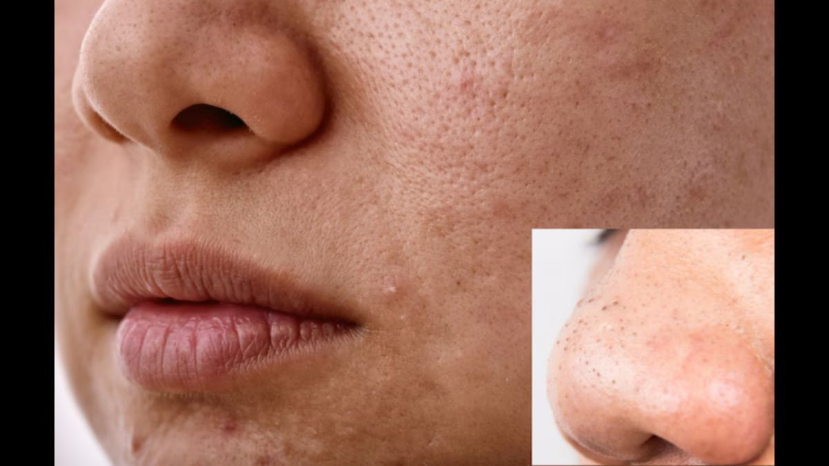 How to Get Rid of Blackheads on Your Nose Overnight: Dermatologist-Approved Tips | Lifestyle News