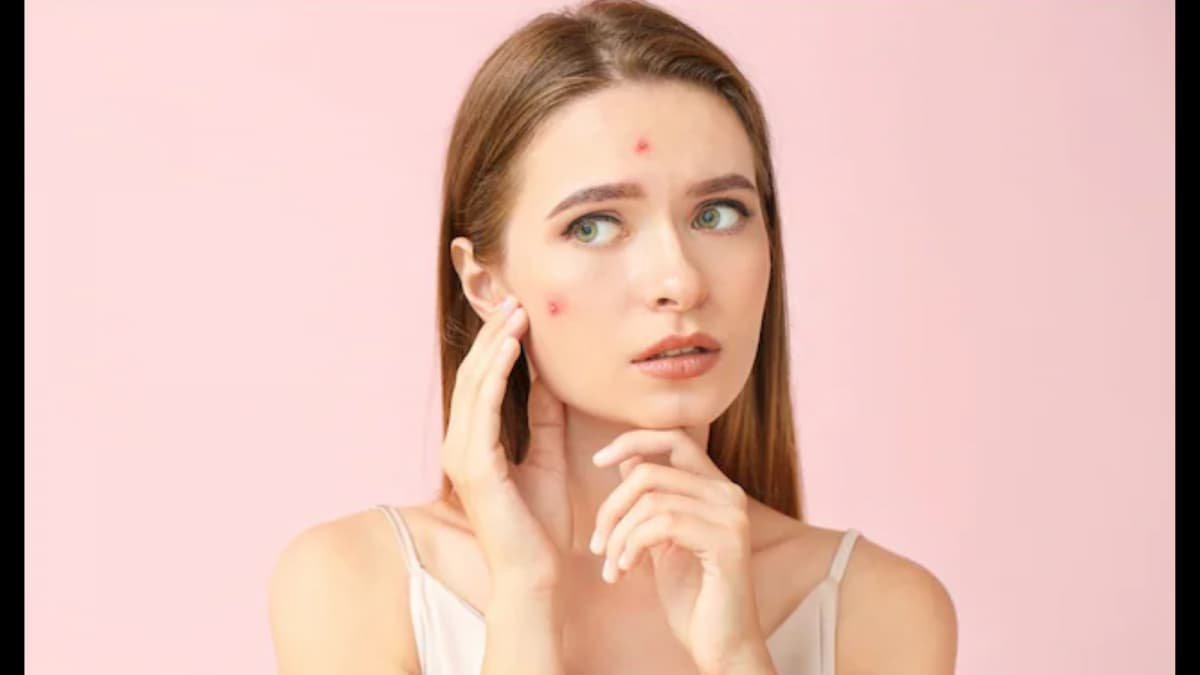 Pimples Getting Worse During The Rainy Season? Here’s How To Keep Your Skin Clear | Lifestyle News