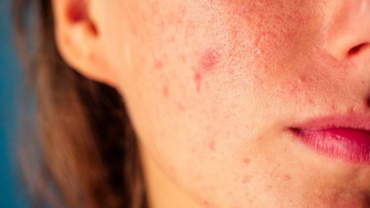 Adult Acne: Why It's On The Rise And What Your Skin Might Be Telling You | Health and Fitness News
